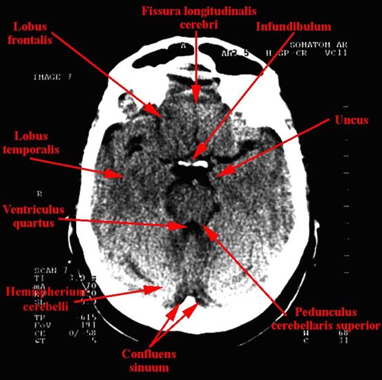 tomografia komputerowa głowy - 06b.jpg