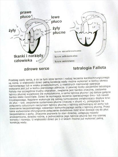 wady serca - Tetralogia Fallota-002.JPG